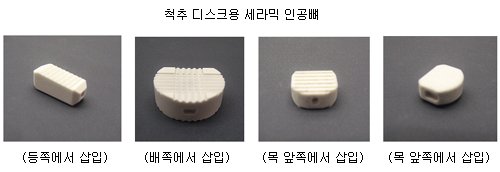 신개념 세라믹 인공뼈 개발