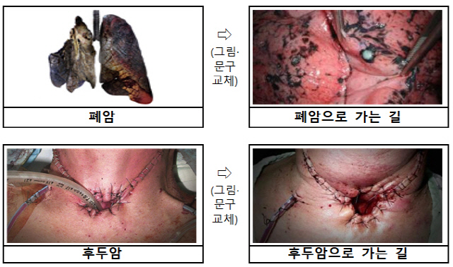 까매진 폐, 구멍 뚫린 목…12월부터 담뱃갑 새 경고 문구·그림